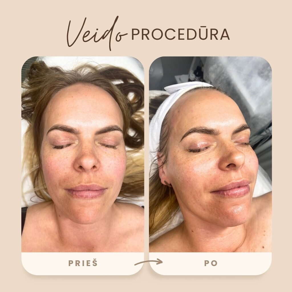 Qskin veido procedūra
