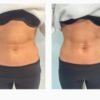 Kombinuota procedūra (1 zonos, šiuo atveju pilvo) RF (QSkin) + EMS